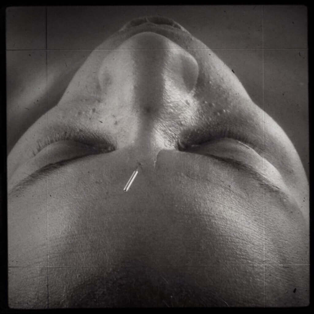 Why Acupuncture?